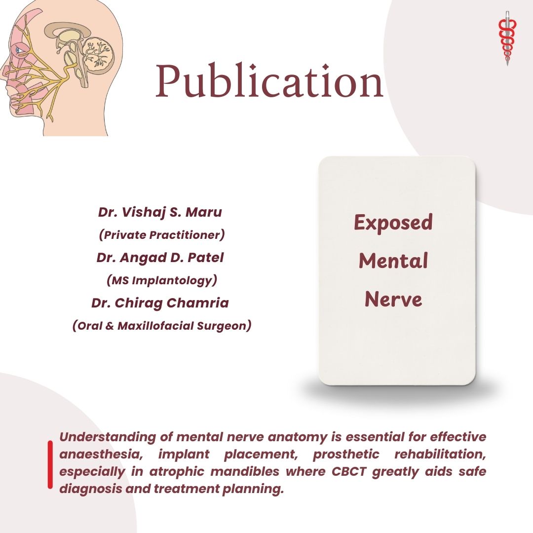 Zygomatic Dental Implant